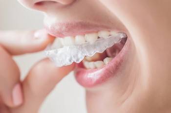 Invisalign